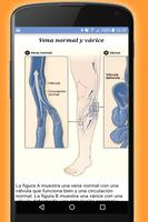 Como eliminar varices en piernas. Tratamiento capture d'écran 2