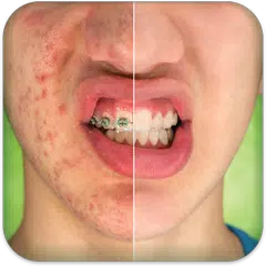 Pimple Remover アプリダウンロード