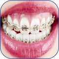 Fake Braces
