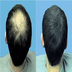 Home Remedies for Hair Loss APK Herunterladen