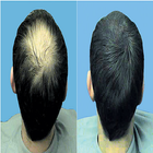 Home Remedies for Hair Loss biểu tượng