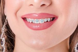 Real Braces Teeth ảnh chụp màn hình 1