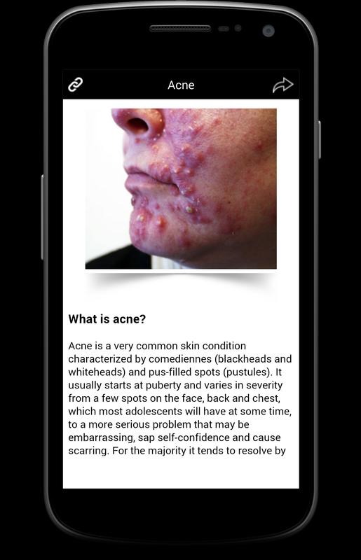 acne a very common skin disease Acne is a skin disease involving the oil glands at the base of hair follicles it affects 3 in every 4 people aged 11 to 30 years acne is a common skin problem. acne a very common skin disease Acne is a skin disease involving the oil glands at the base of hair follicles it affects 3 in every 4 people aged 11 to 30 years acne is a common skin problem.