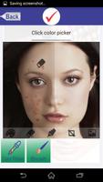 Pimple Acne Photo Editor poster