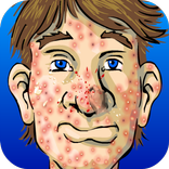 เกมส์บีบสิว