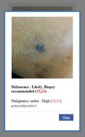 AI Melanoma (Skin Cancer) Detection Affiche