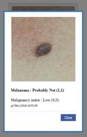 AI Melanoma (Skin Cancer) Detection capture d'écran 1
