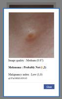 AI Melanoma (Skin Cancer) Detection capture d'écran 3