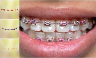 Real Teeth Braces Photo Maker capture d'écran 1