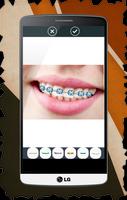 Braces For Teeth (Real Look) Screenshot 2