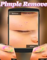 Face Blemishes Cleaner & Face Pimple Removal capture d'écran 2