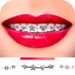Braces Camera