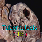 Tuberculosis TB ícone