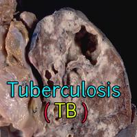 Tuberculosis TB Cartaz