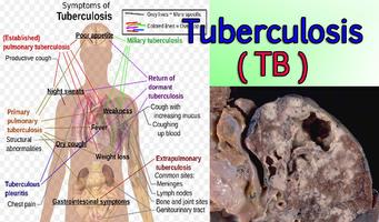 Tuberculosis TB imagem de tela 1