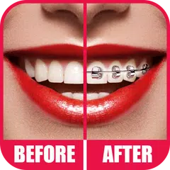 Braces 2.0 APK Herunterladen