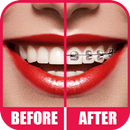 Braces 2.0 APK