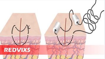 Surgery Stitching Techniques 海报