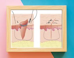 Surgery Stitching Techniques 截图 1