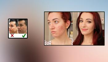 Acne Scar Removal Home Remedies Affiche