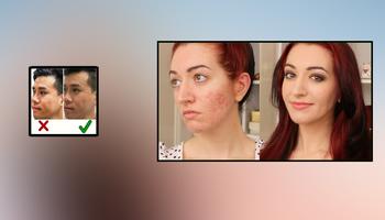 Acne Scar remoção Home remedies Cartaz