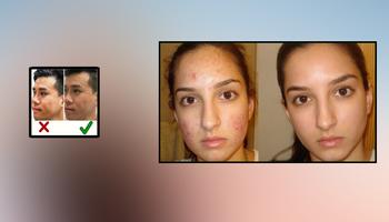 Acne Scar remoção Home remedies imagem de tela 1