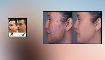 Acne Scar remoção Home remedies imagem de tela 2