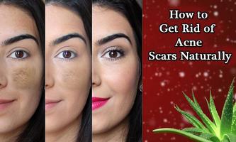 Remove Acne in 7 Days Guide الملصق