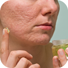 آیکون‌ Acne Scar Removal Tips and Tricks