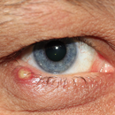 APK Eyes / Aankhon Infection Ka Ilaj