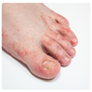 APK Foot Fungus Ka Ilaj