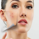 ব্রণের গর্ত নির্মূল(প্রাকৃতিক)