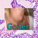 Goiter