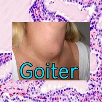 Goiter Poster