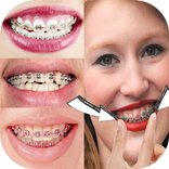 Fake Braces  Photo Editor