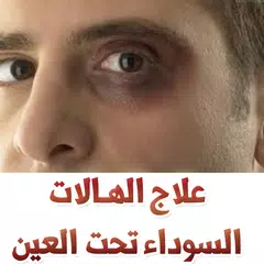 علاج الهالات السوداء تحت العين