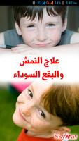 علاج النمش والبقع السوداء Affiche