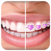 Braces App that look Real for Boys & Girls