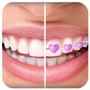 Braces App that look Real for Boys & Girls APK