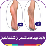 وصفات علاج تشقق القدمين طبيعيا ikona