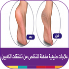 ikon وصفات علاج تشقق القدمين طبيعيا