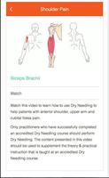 Dry Needling ảnh chụp màn hình 1