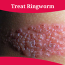 How To Treat Ringworm-APK