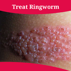 How To Treat Ringworm icône