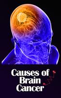 Causes of Brain Cancer Affiche