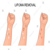 Lipoma Solution Disease icône