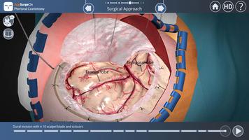 Pterional Craniotomy Plakat