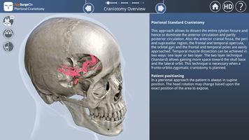 Pterional Craniotomy ภาพหน้าจอ 1