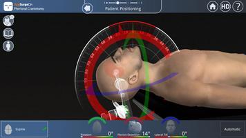Pterional Craniotomy Screenshot 2