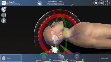 Pterional Craniotomy Ekran Görüntüsü 2